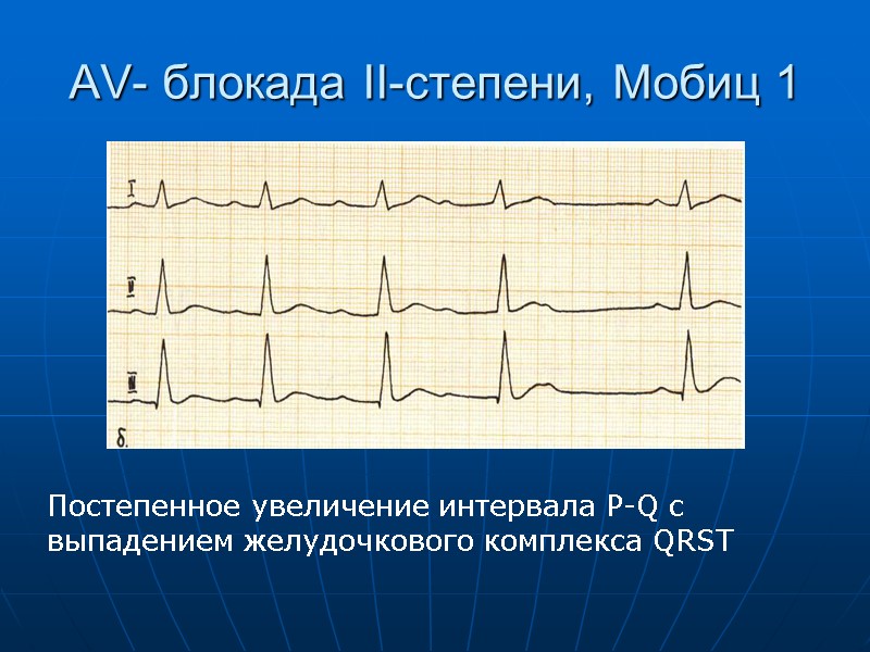 AV- блокада II-степени, Мобиц 1 Постепенное увеличение интервала P-Q c выпадением желудочкового комплекса QRST
